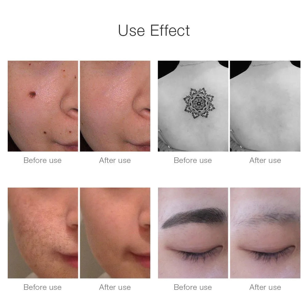 Neatcell Picosecond Laser Pen: Skin Care Beauty Device